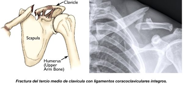 Fracturas de clavícula - Synergia