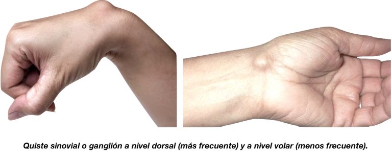 Gangliones o quistes sinoviales de muñeca - Synergia