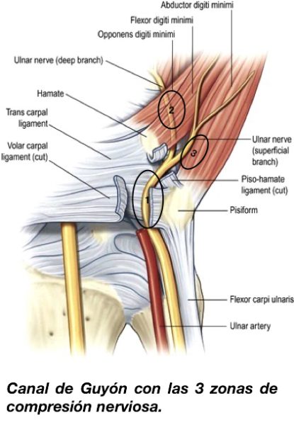 S ndrome Del Canal De Guy n O Neuropat a Cubital Synergia s-ndrome-del-canal-de-guy-n-o-neuropat-a-cubital-synergia